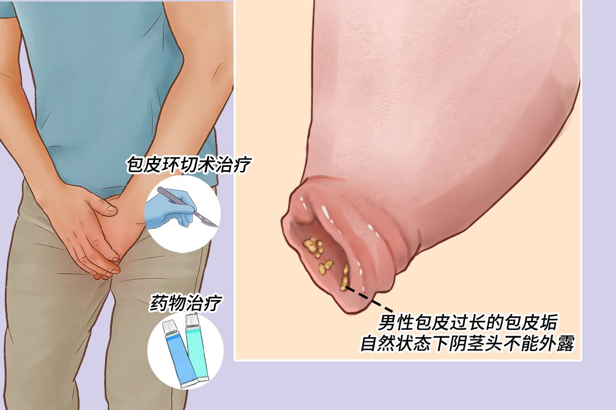 包皮 垢