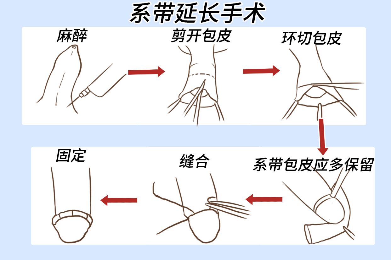 系带延长手术图片