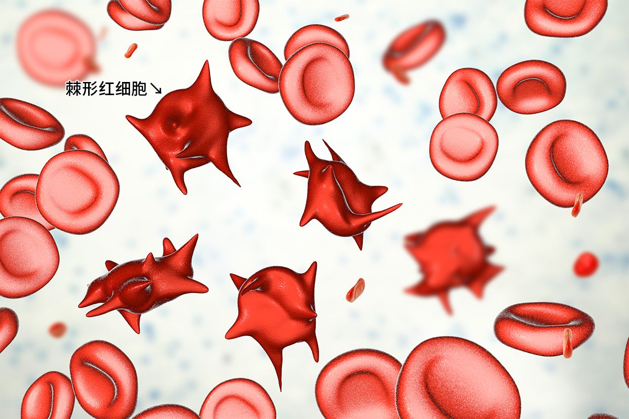 棘形红细胞的形态图片