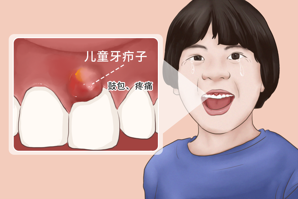 儿童牙疖子症状图片
