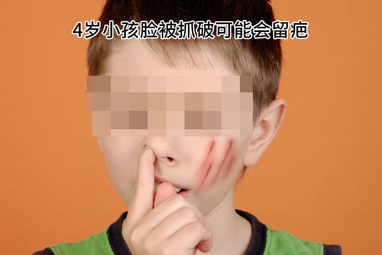 4岁小孩脸被抓破可能会留疤图片