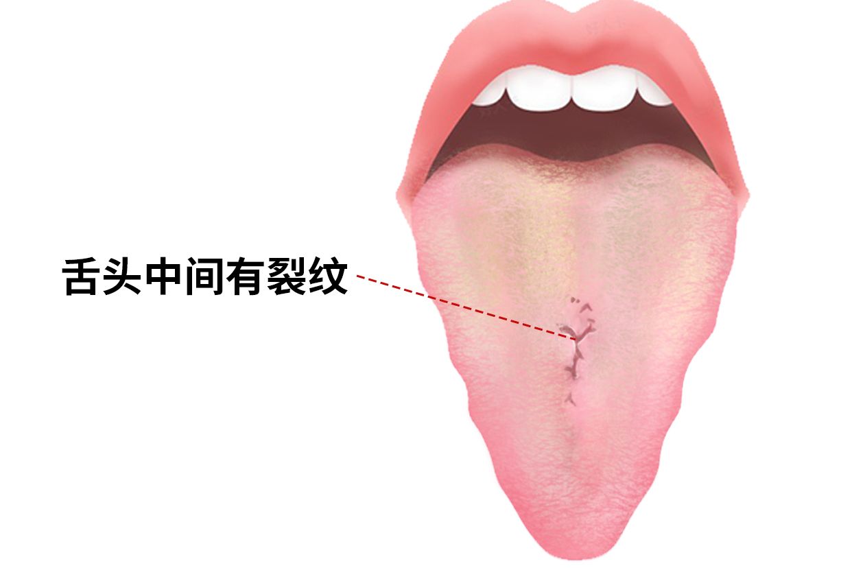 舌头中间有裂纹图片