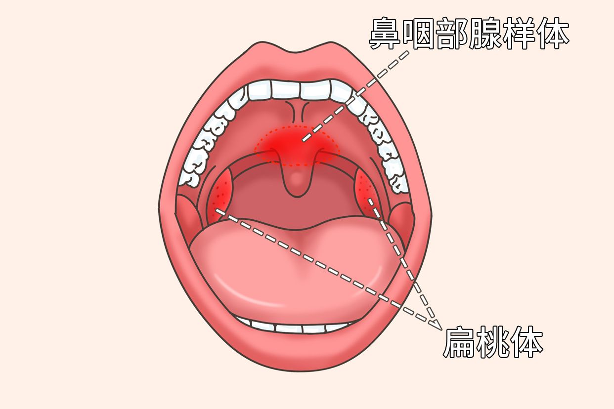 鼻咽部腺样体图片