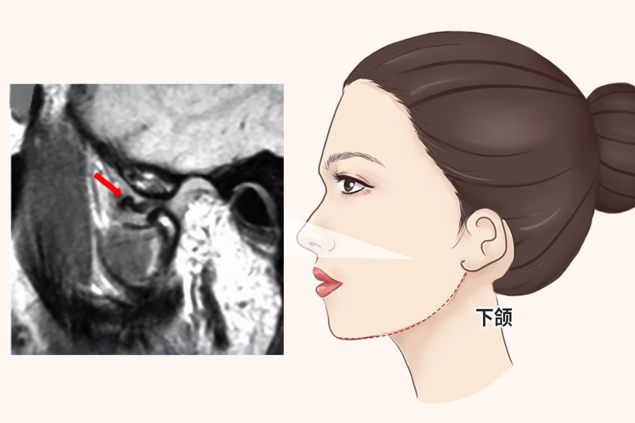 下颌磁共振照片