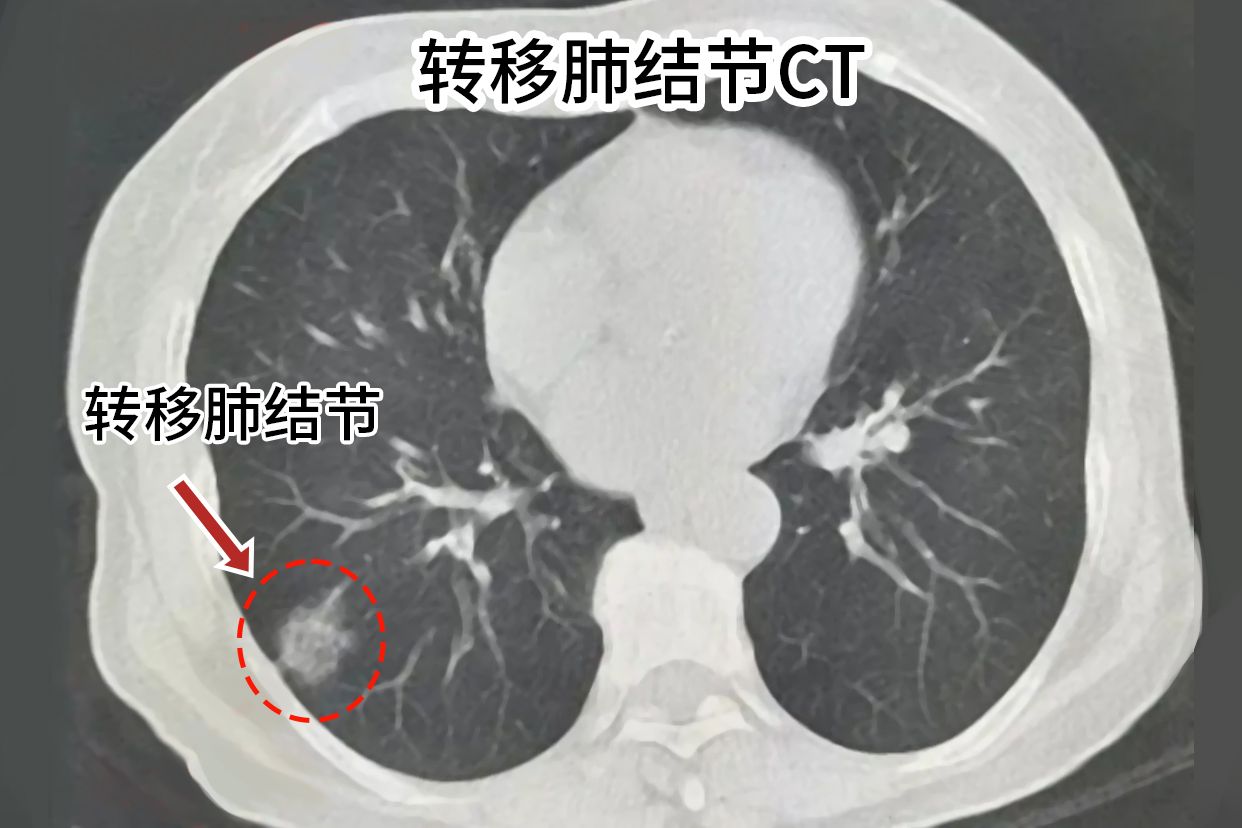 转移肺结节CT图