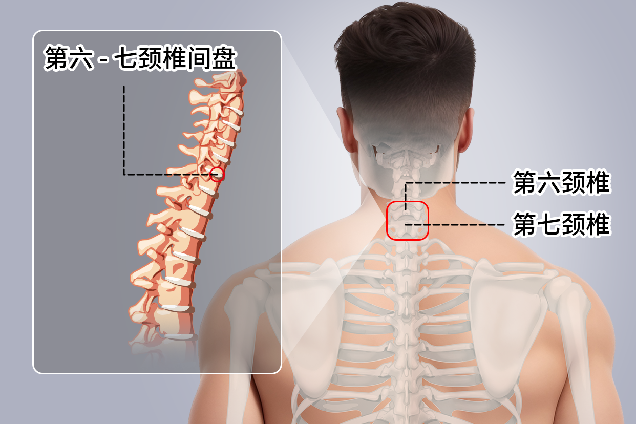 第六颈椎到第七颈椎的椎间盘位置图