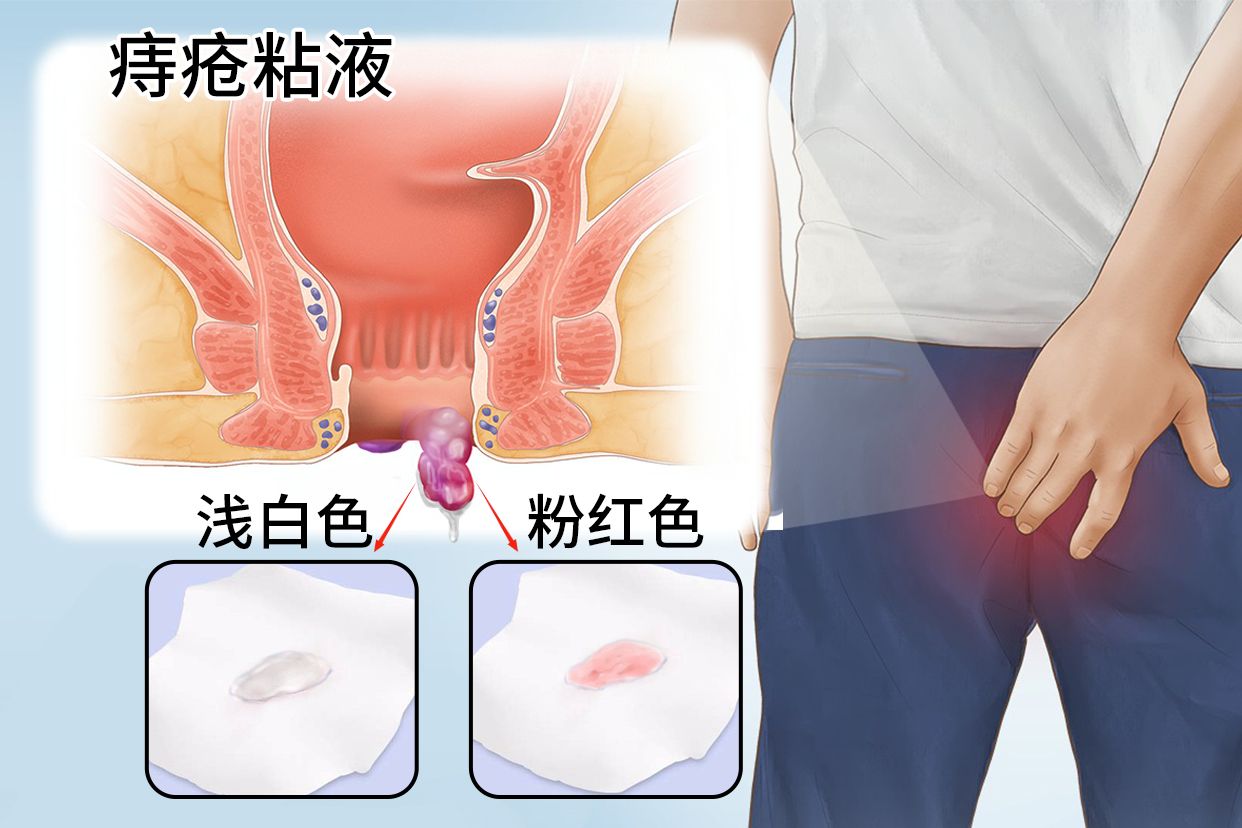 痔疮粘液是什么颜色图片