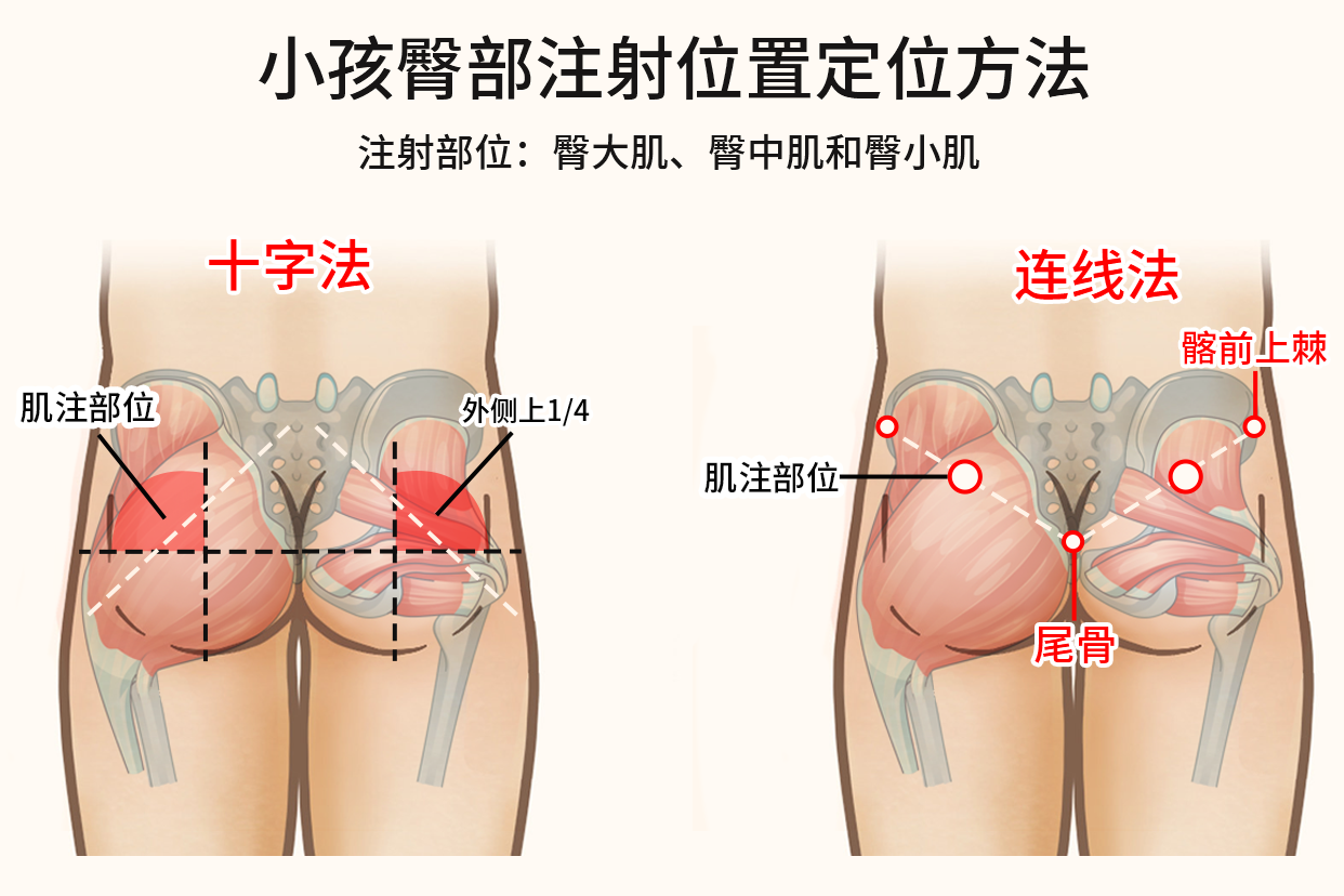 小孩臀部注射位置定位方法图