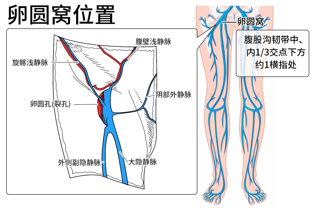 卵圆窝位置图片