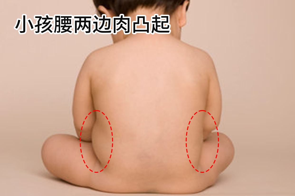 小孩腰两边肉凸起的图片
