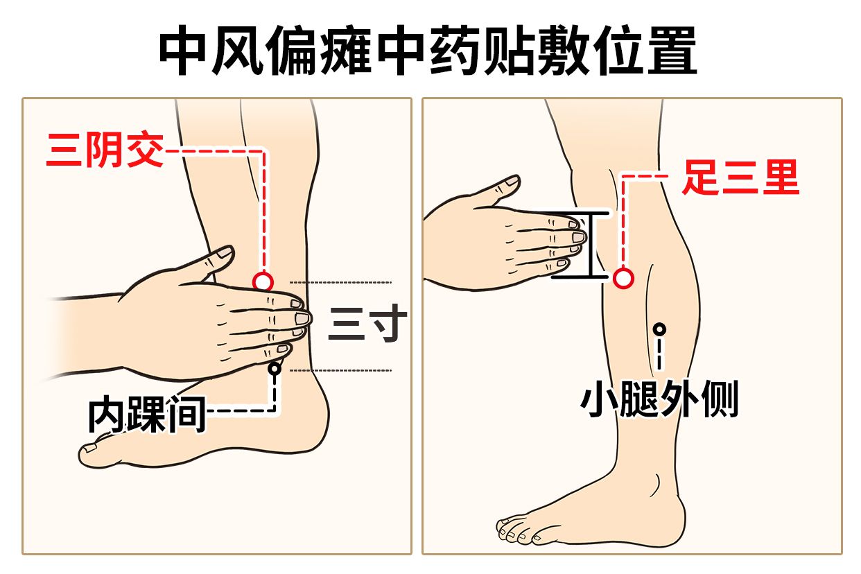 中风偏瘫中药贴敷位置图片