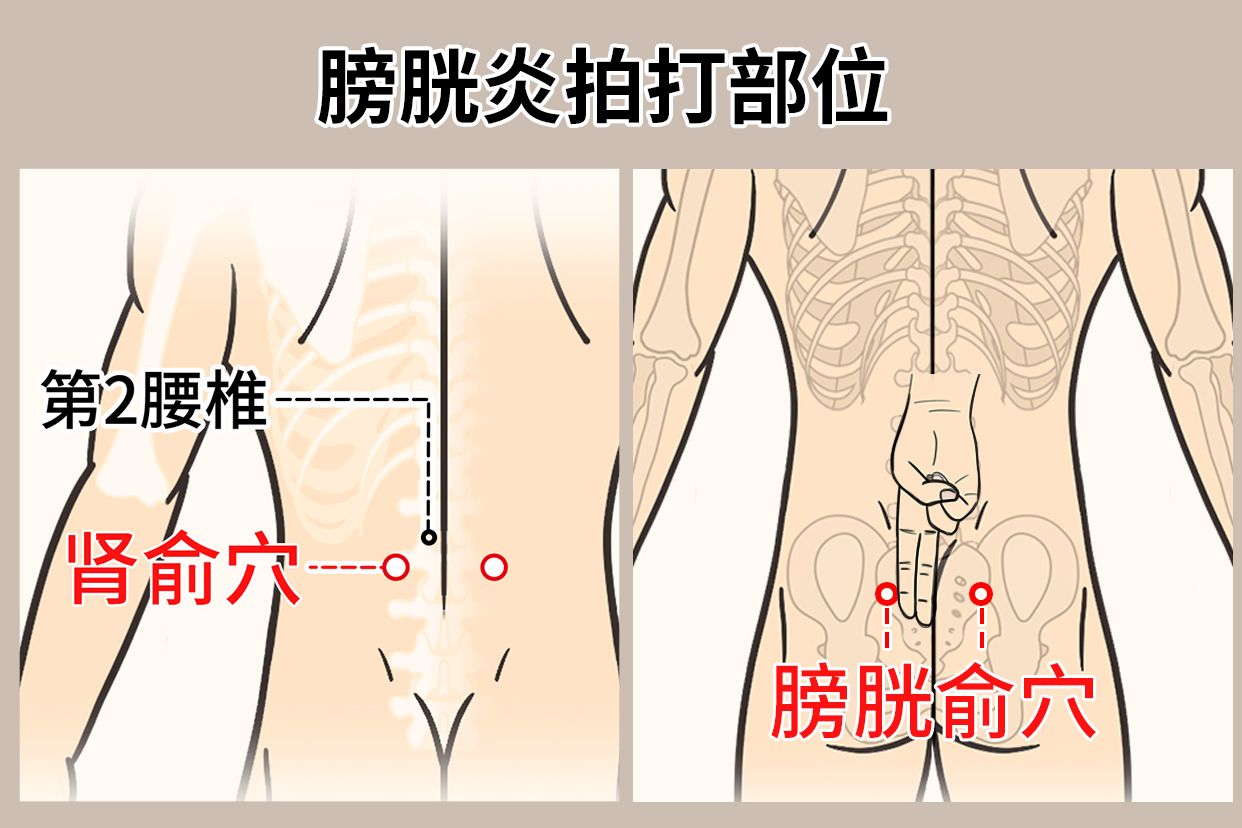 膀胱炎拍打部位图