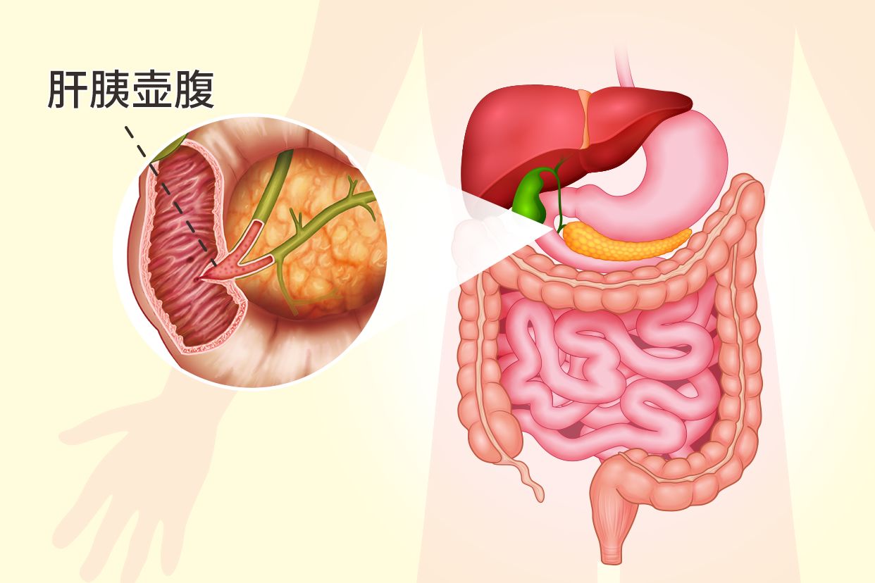 肝胰壶腹部在哪个位置图片