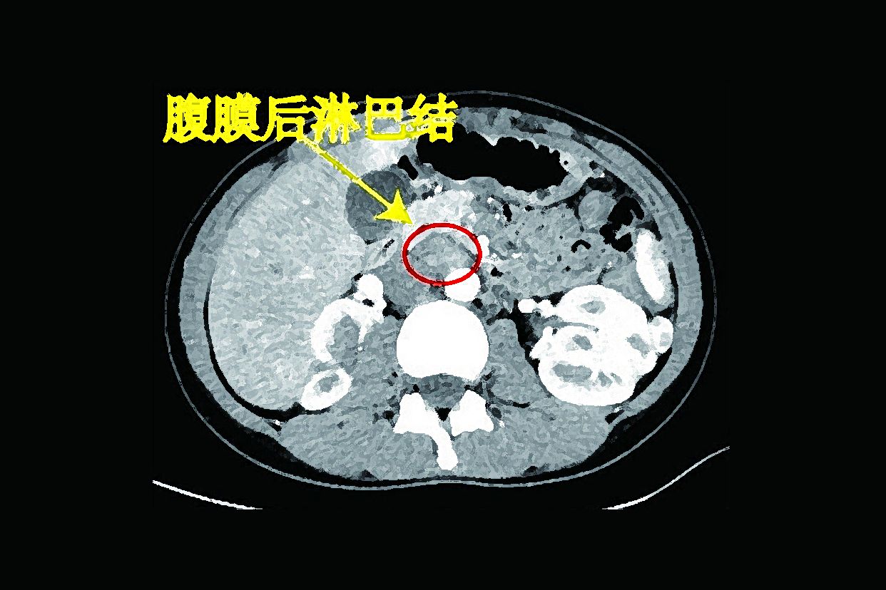 内乳淋巴结ct片图解图片