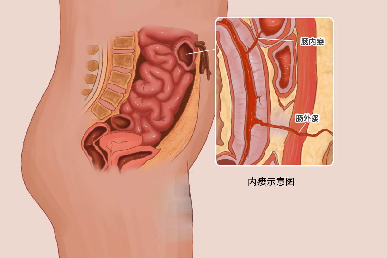 内瘘示意图