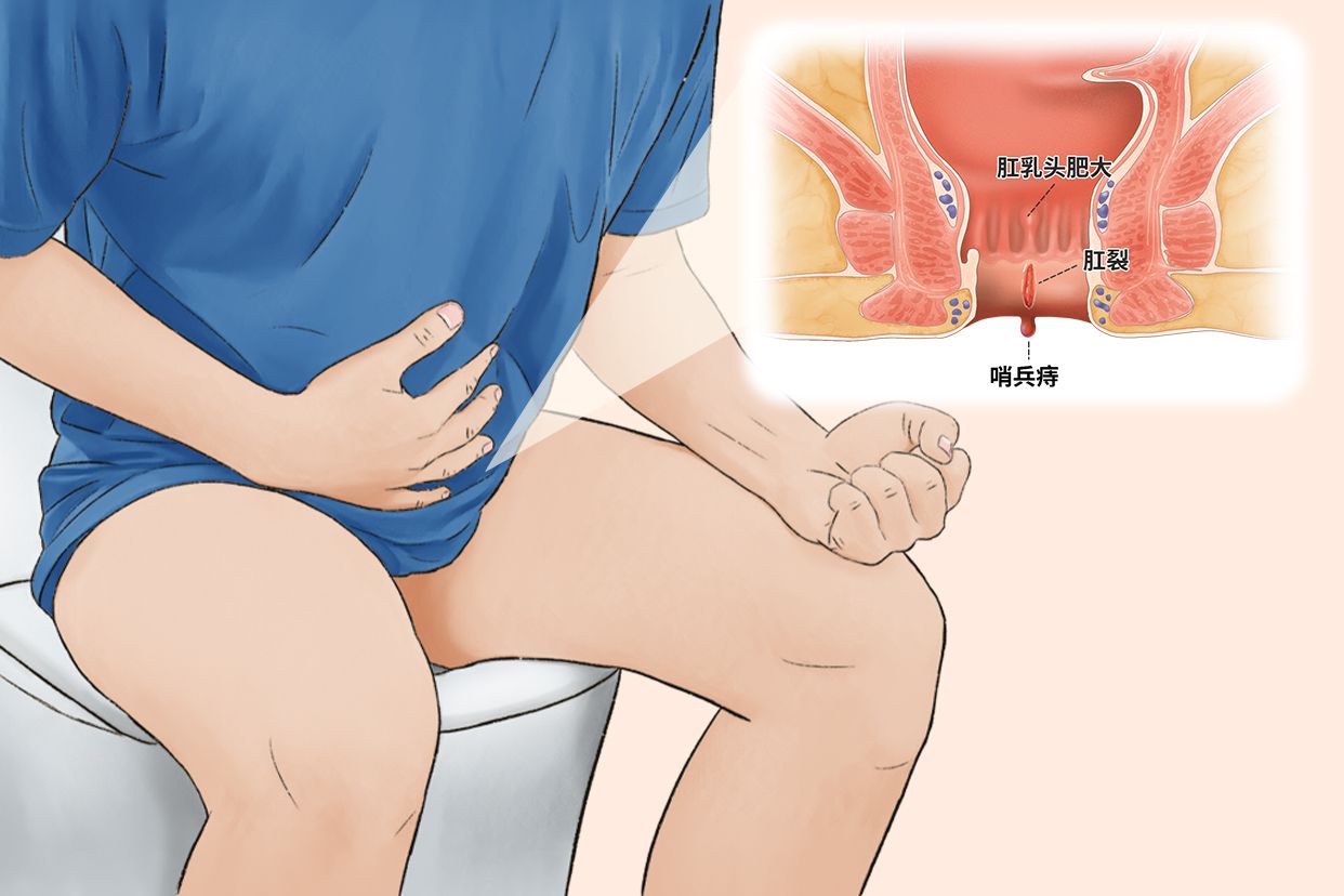 肛裂前哨痔图片