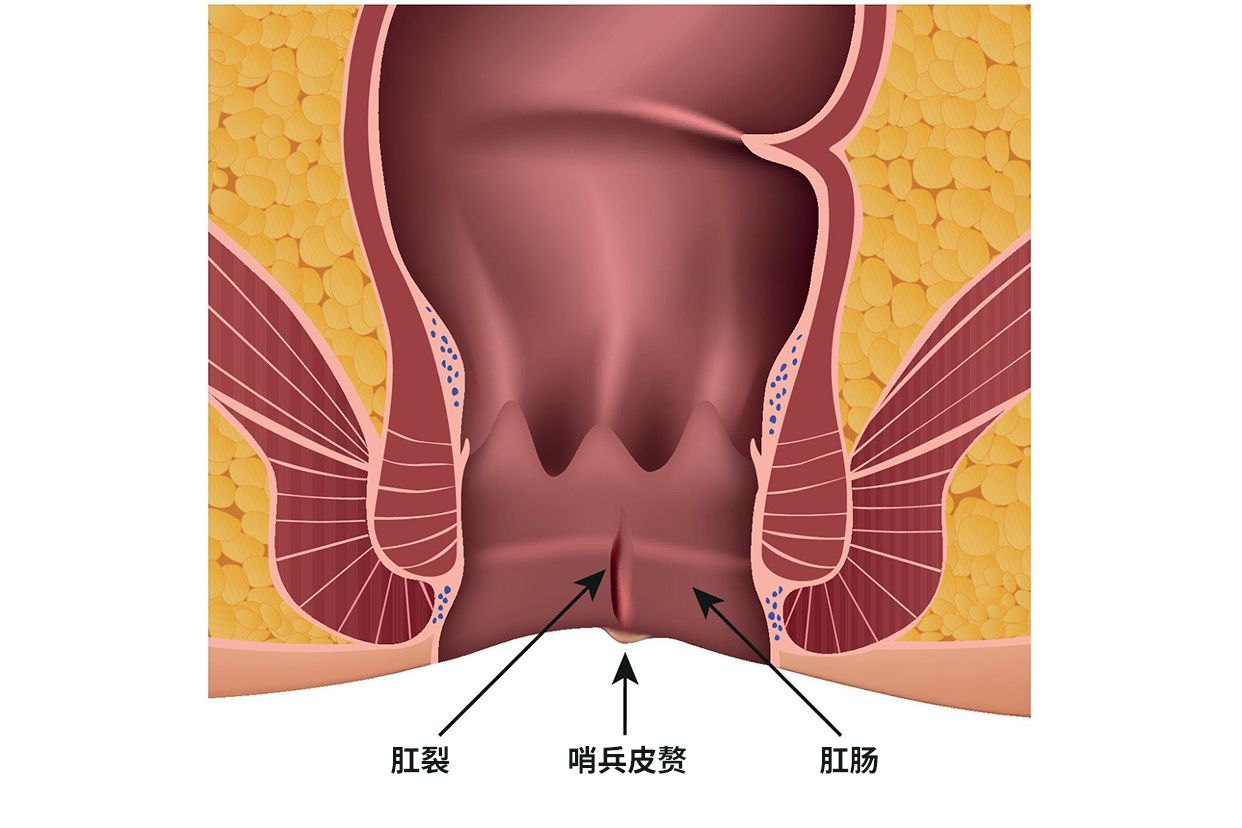 肛裂严重图片 裂口图片