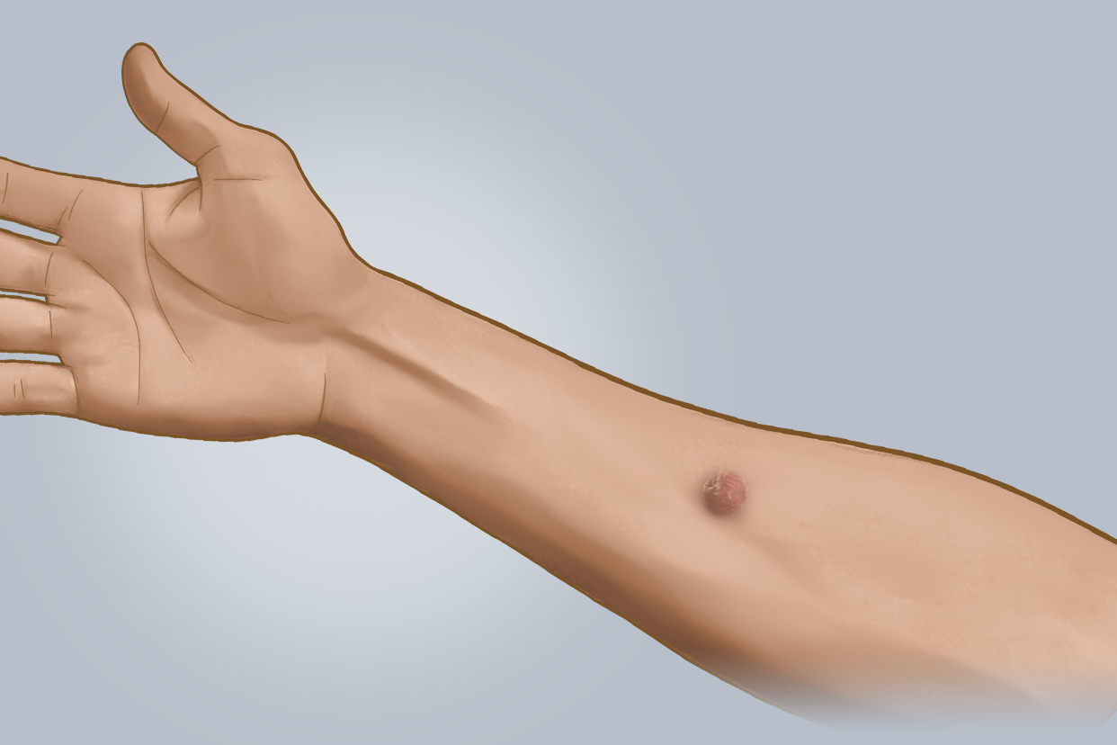 皮下结节恶性图片