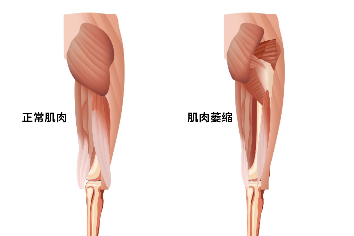 髋关节肌肉萎缩图片