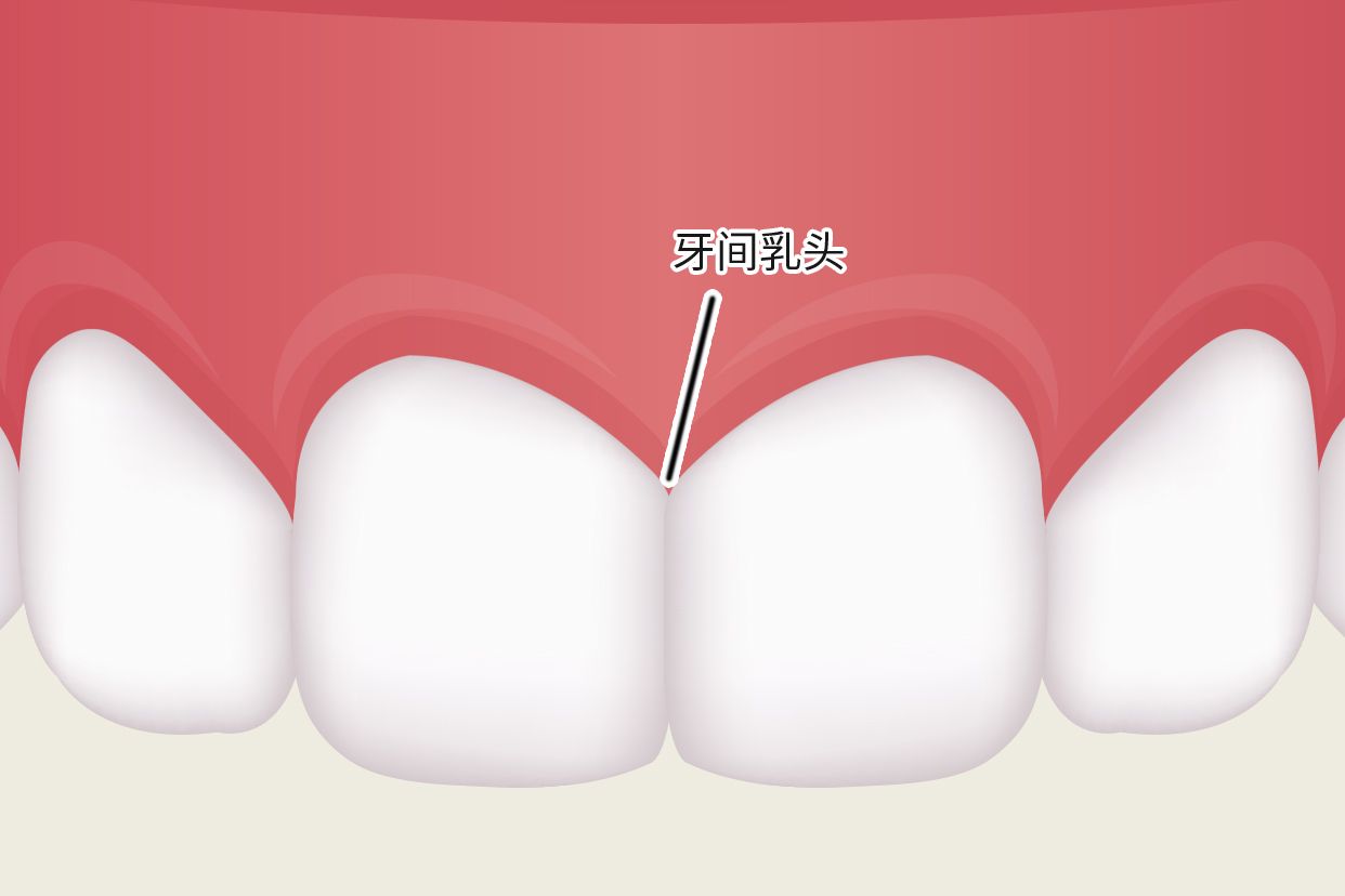 牙间乳头图片