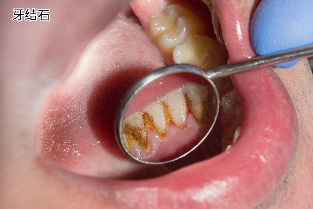 牙结石的主要症状有哪些？为什么会发生牙结石呢？-京东健康