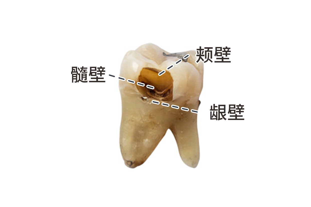 口腔二类洞龈壁图解