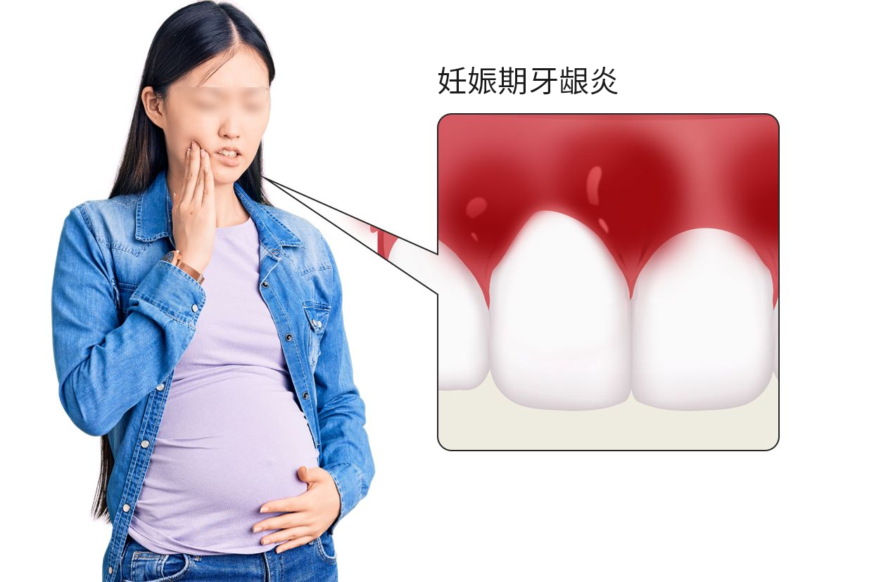妊娠期牙龈炎图片