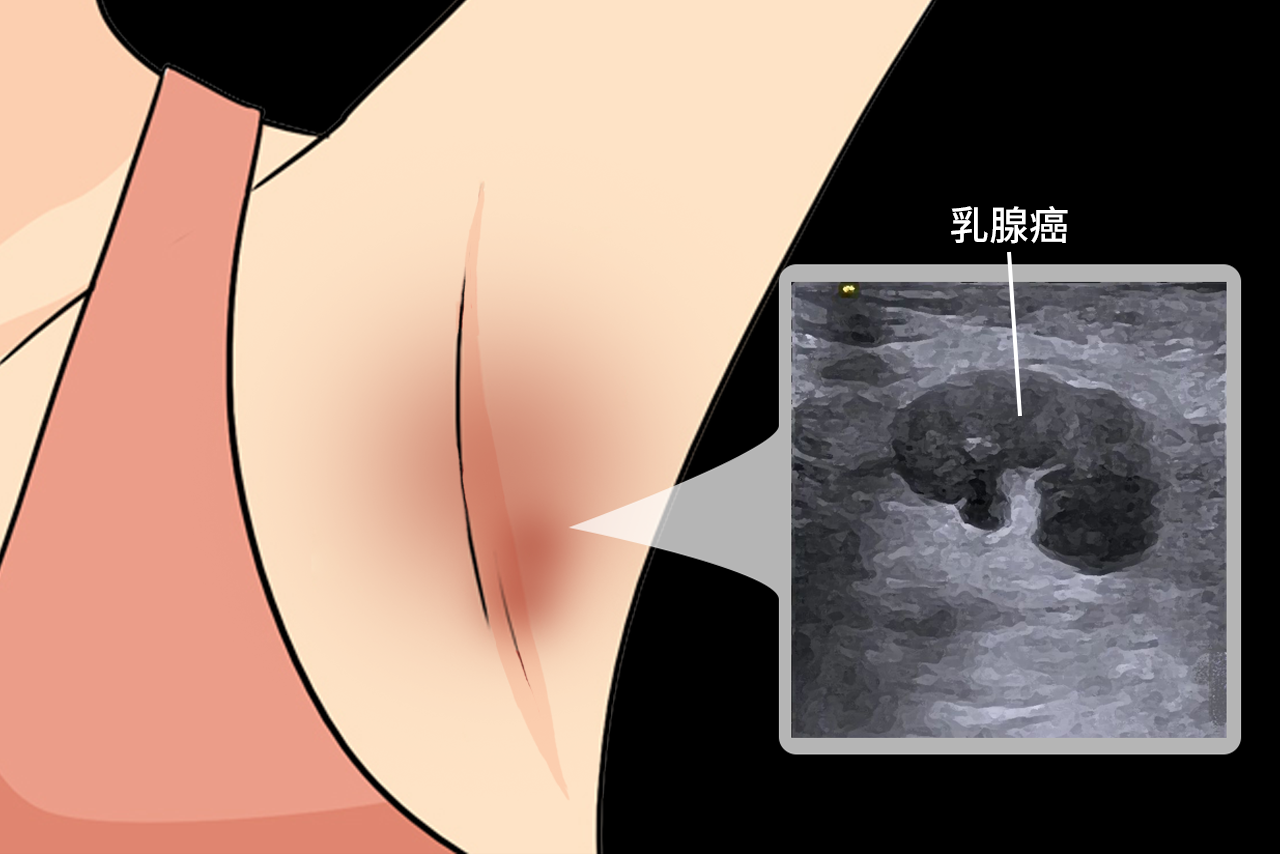 乳腺癌转移到腋下淋巴图片