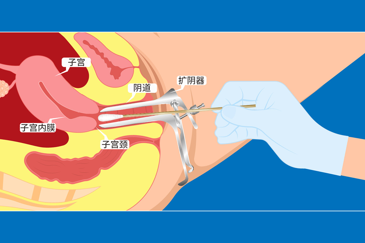 擴 陰