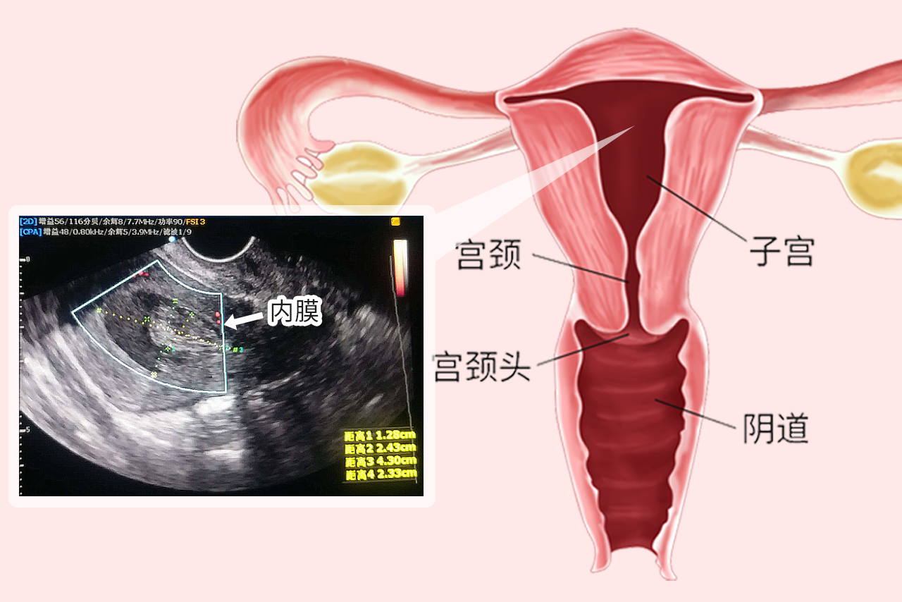子宫内膜彩超图