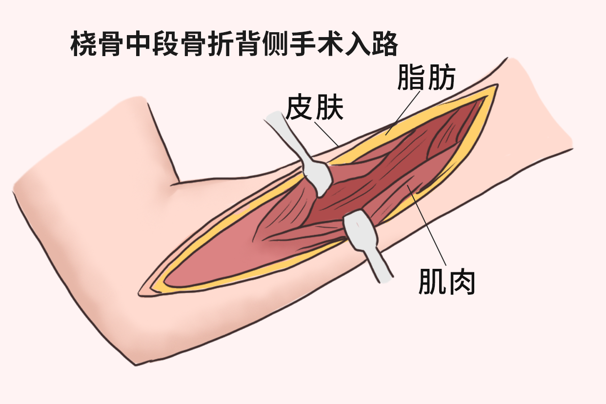 桡骨中段骨折背侧手术入路图片