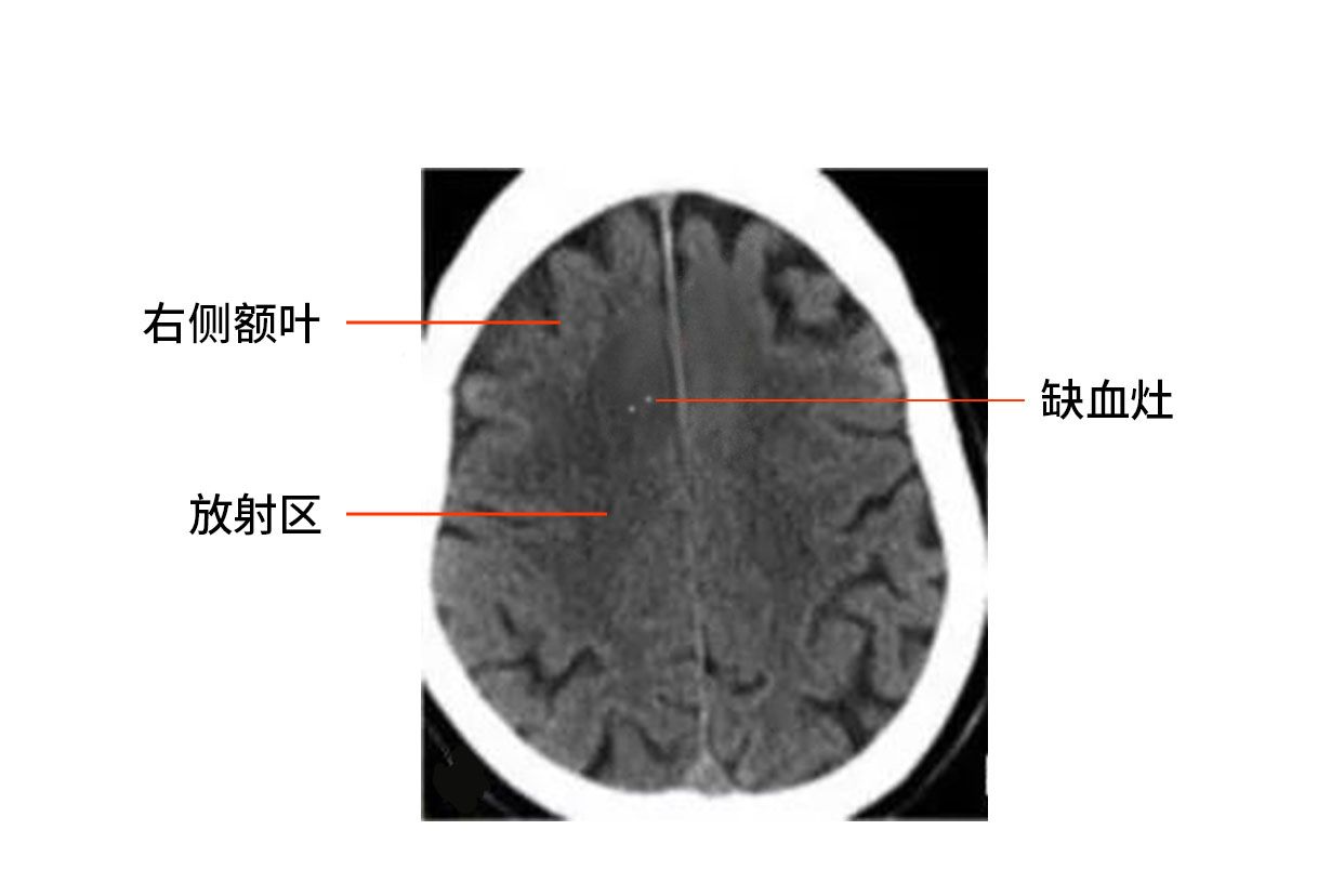 右侧额叶缺血灶显示低密度区图