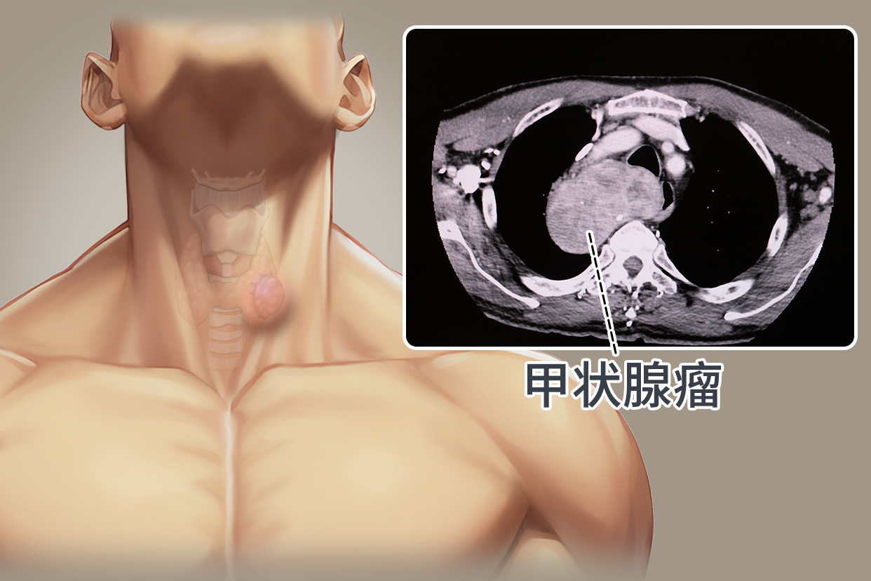 胸内甲状腺瘤图片