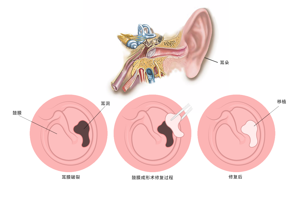 鼓膜修复术图片