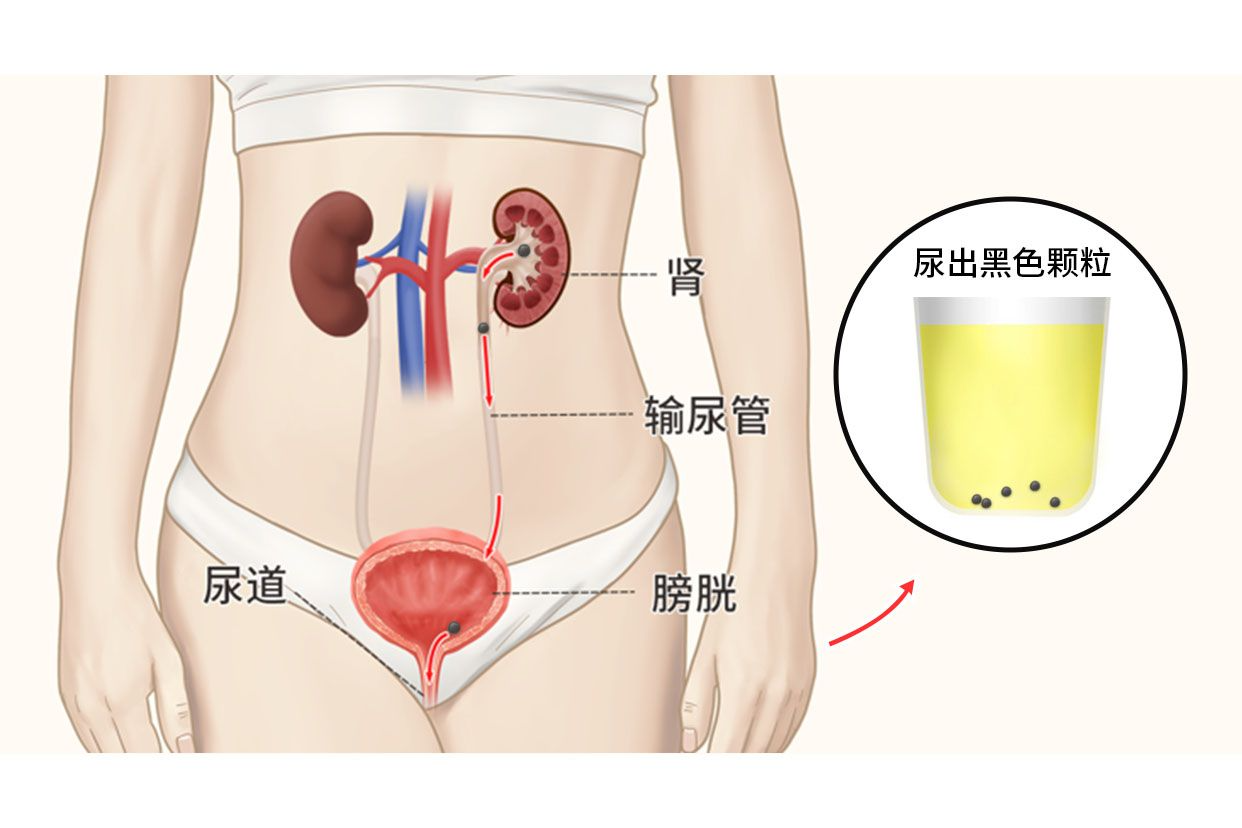 尿出黑色颗粒图