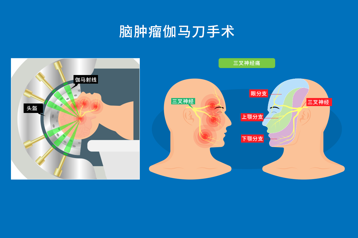 脑肿瘤伽马刀手术图片