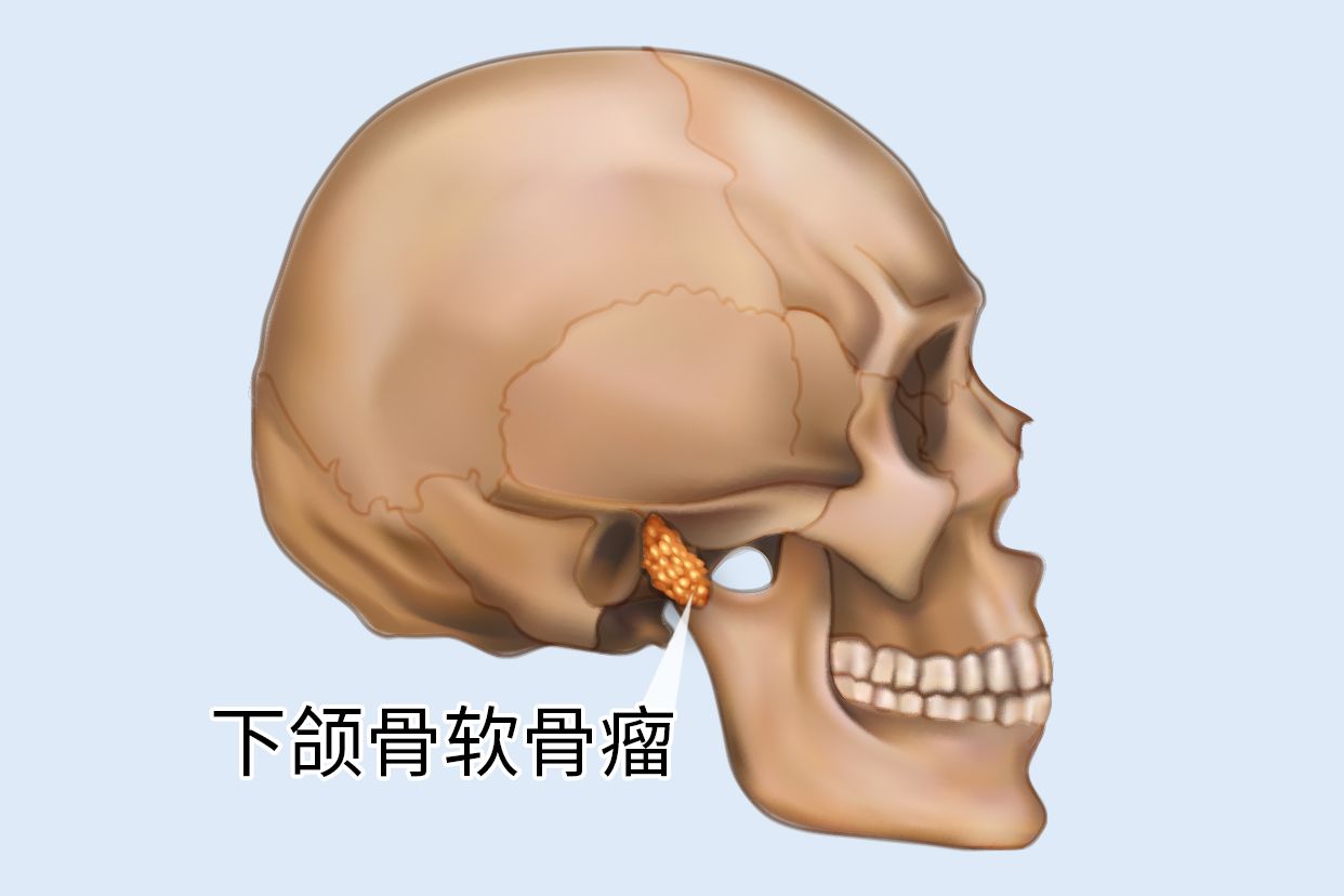 下颌骨软骨瘤图片