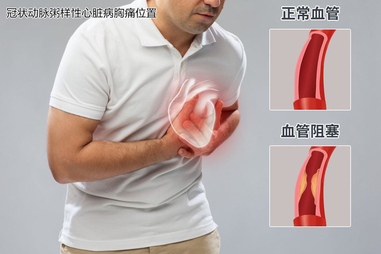 冠状动脉粥样硬化性心脏病胸痛位置图