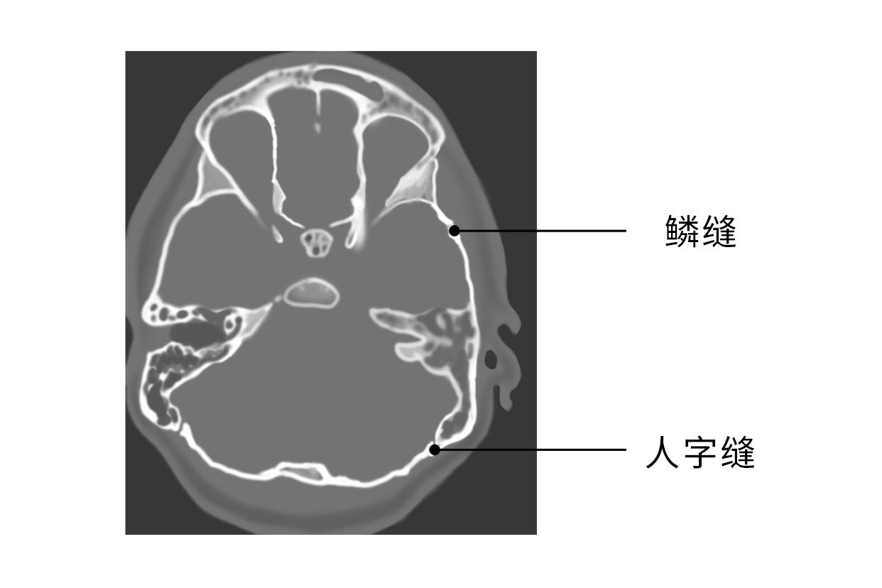 正常颅缝CT图