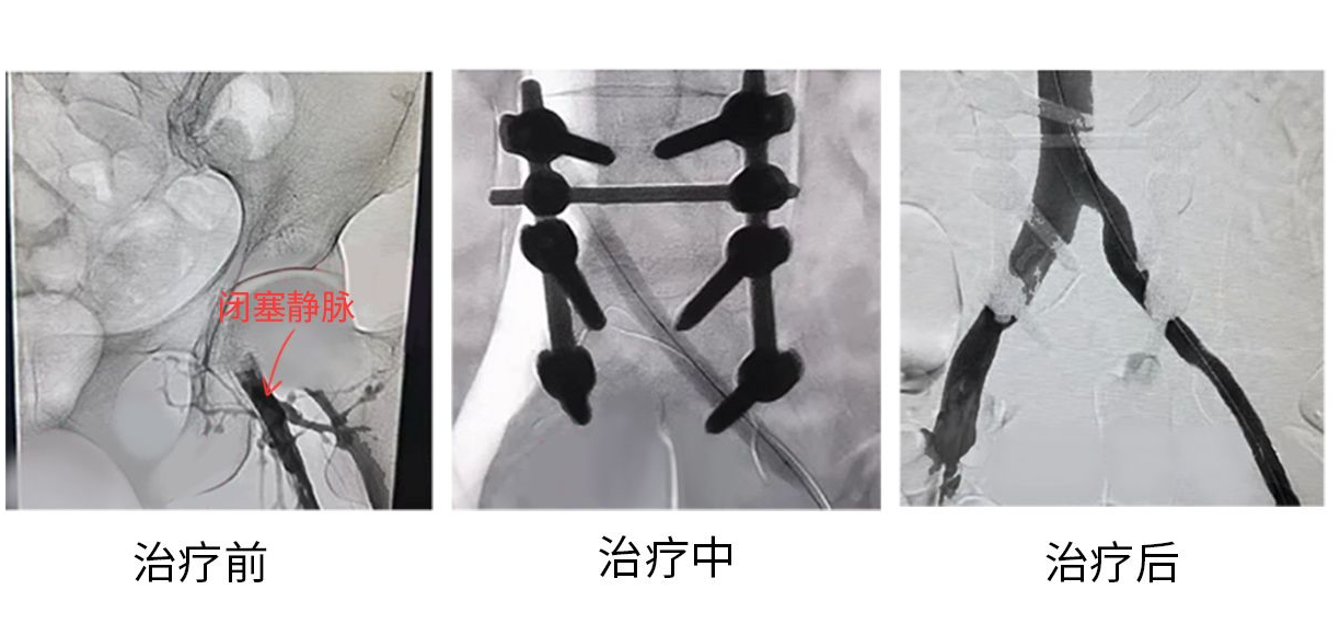 血栓再通图片