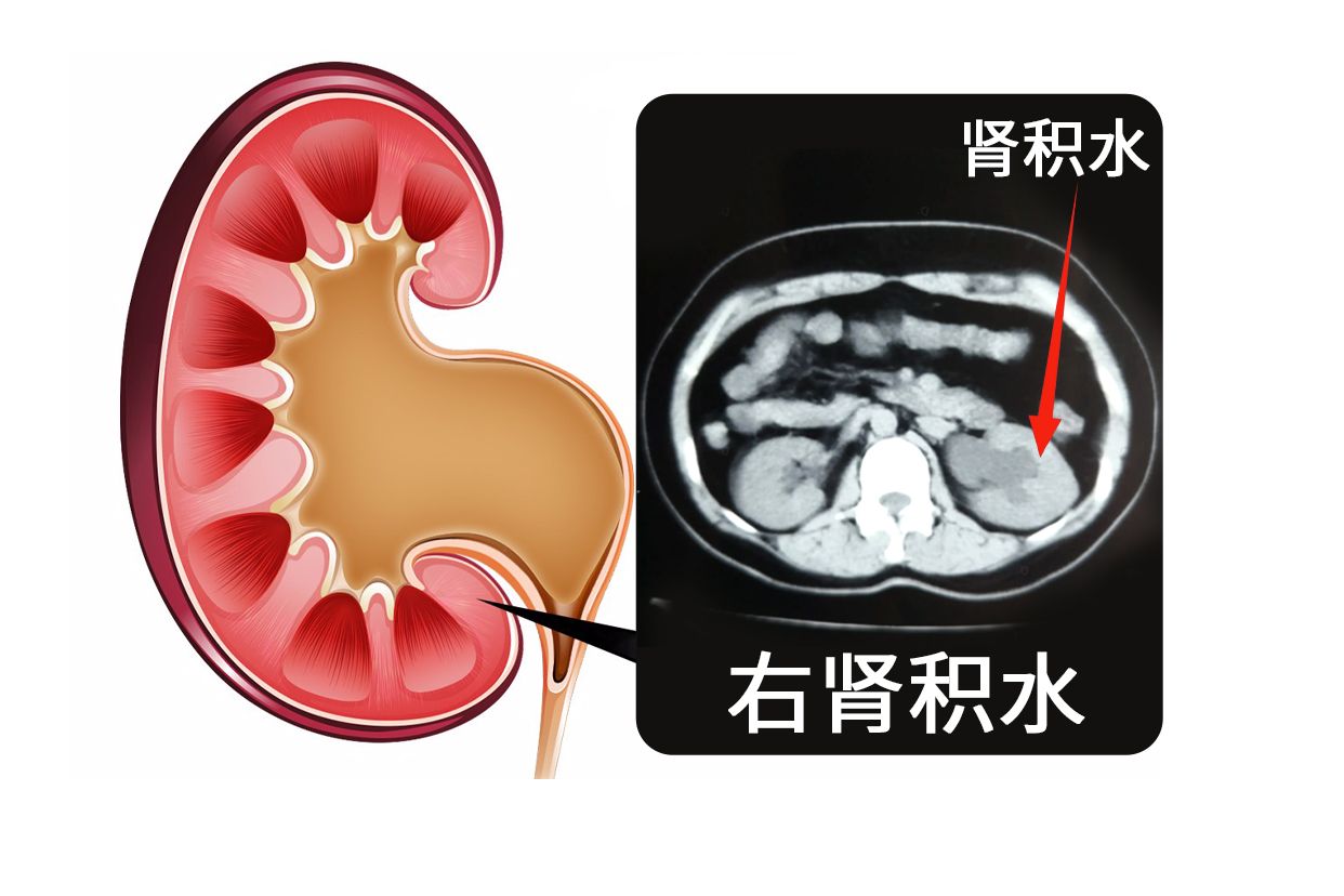 肾积水CT影像图片