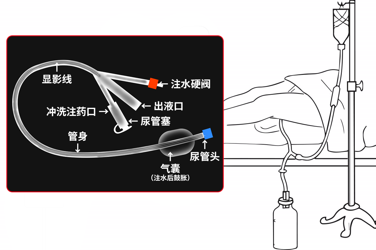 三腔膀胱冲洗示意图