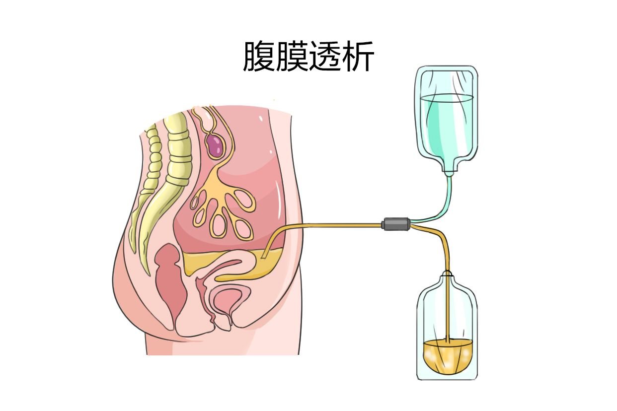 腹膜透析原理图