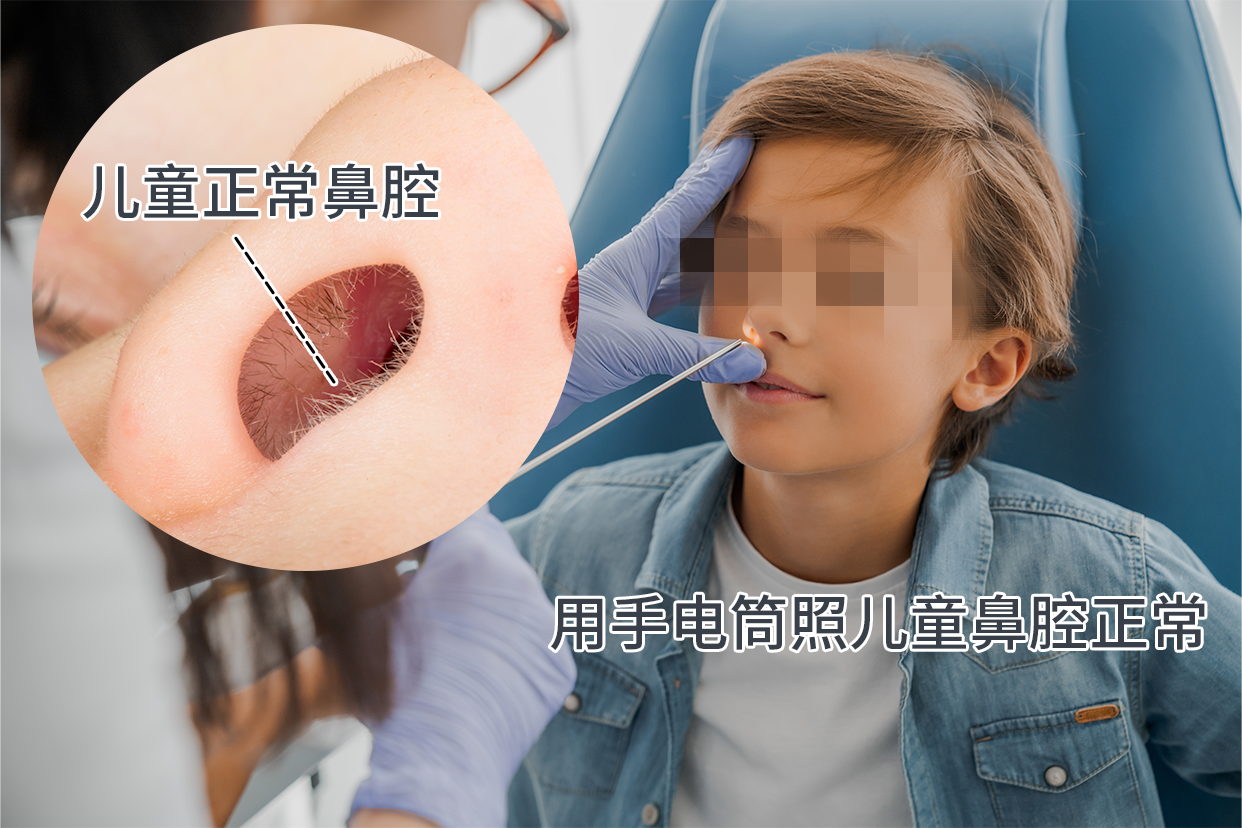 用手电筒照儿童鼻腔正常图