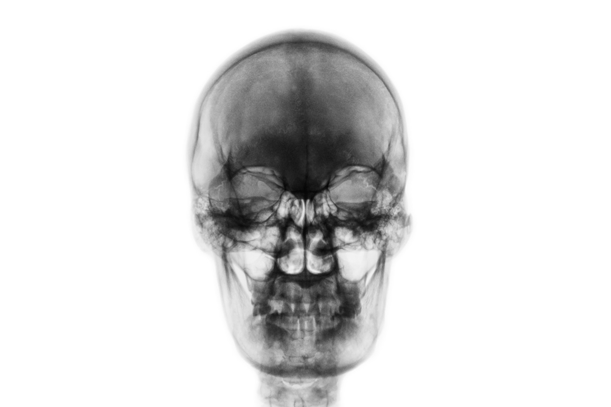 颅骨X光图片
