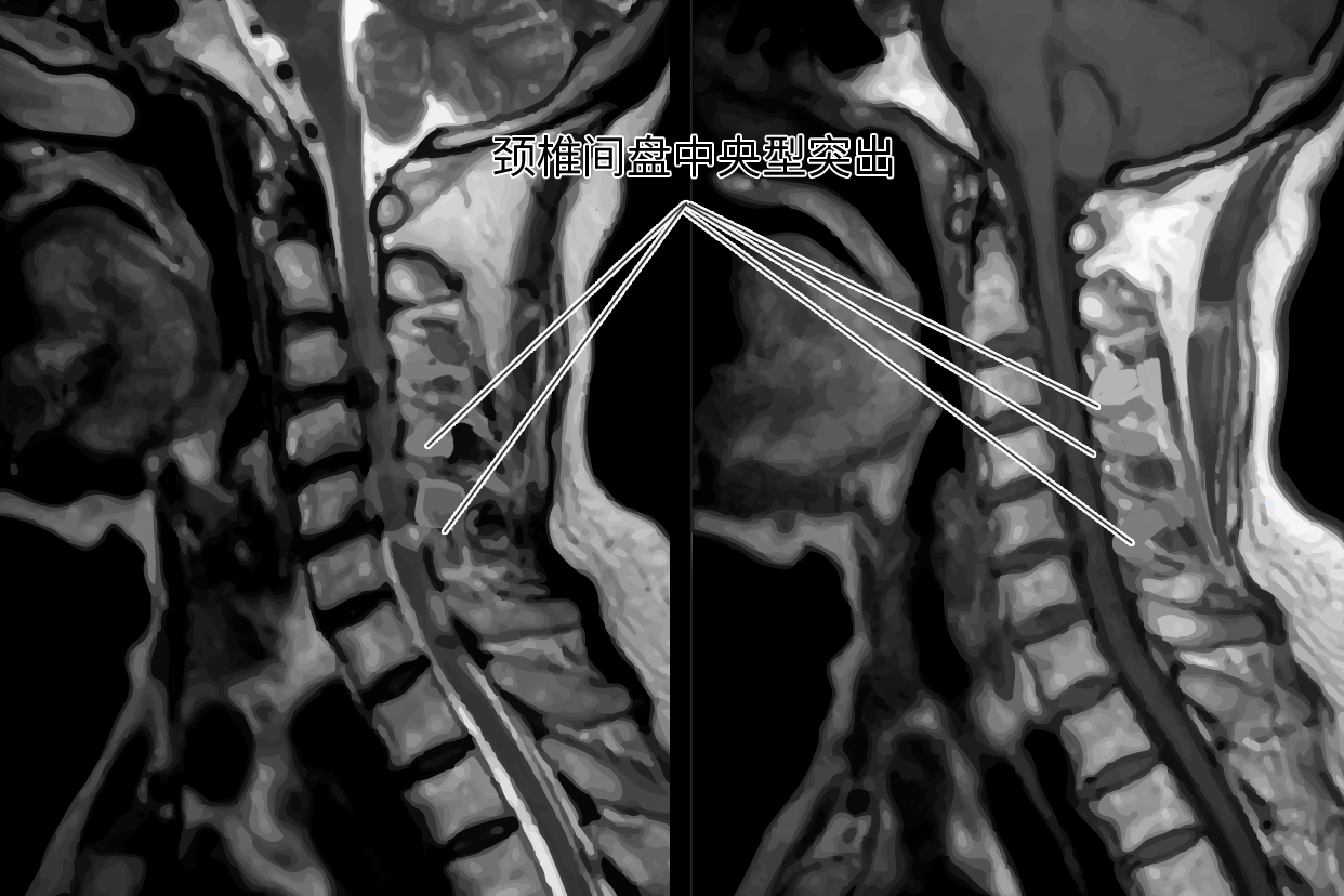 颈椎间盘中央型突出图片