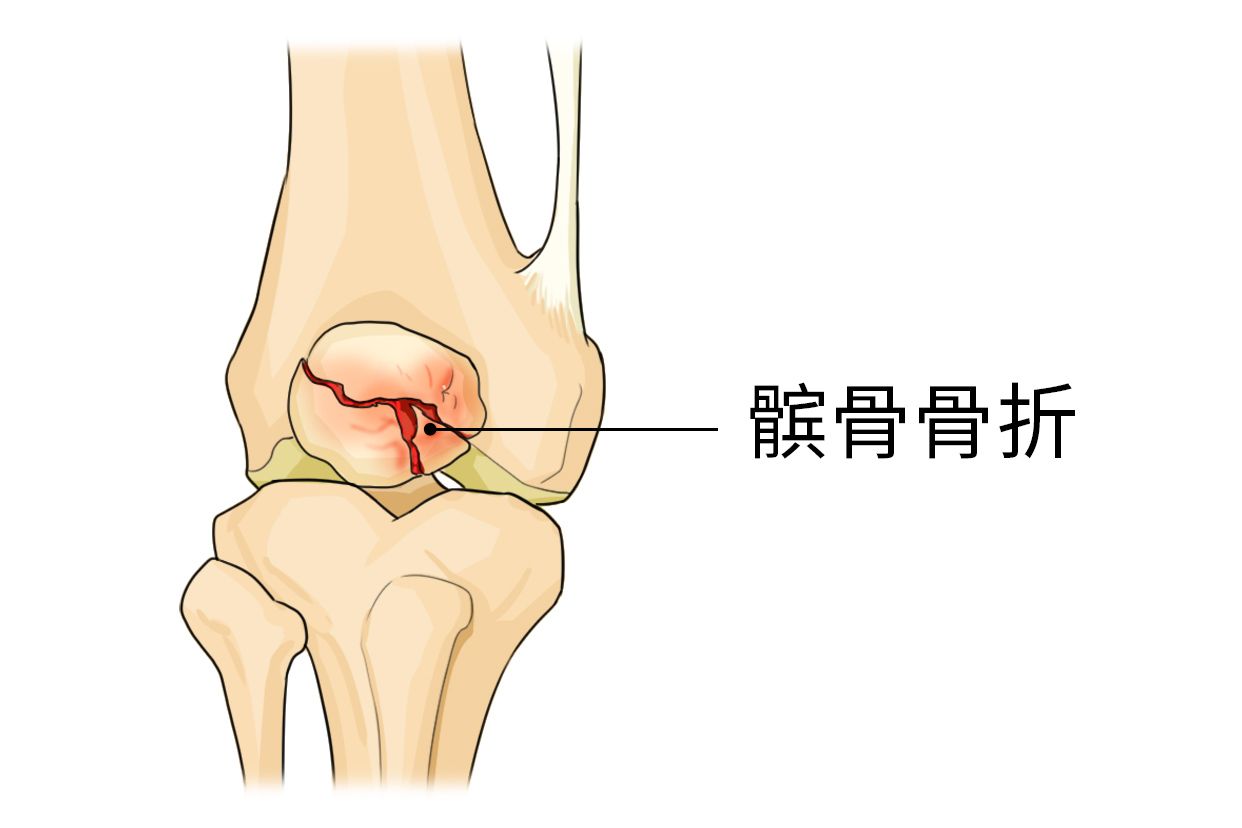 髌骨是什么位置图图片