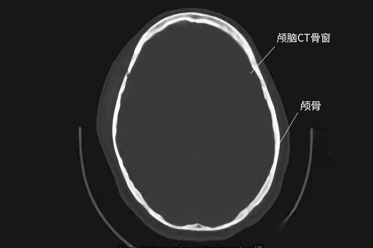 颅脑CT骨窗解剖图