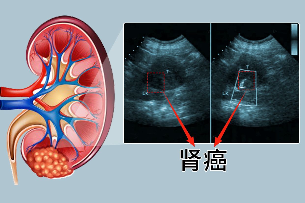 肾癌超声图片