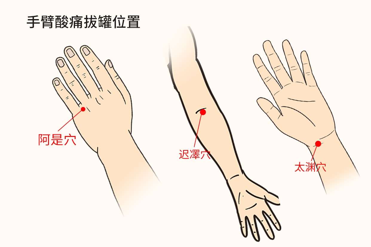 手腕疼拔罐位置示意图图片